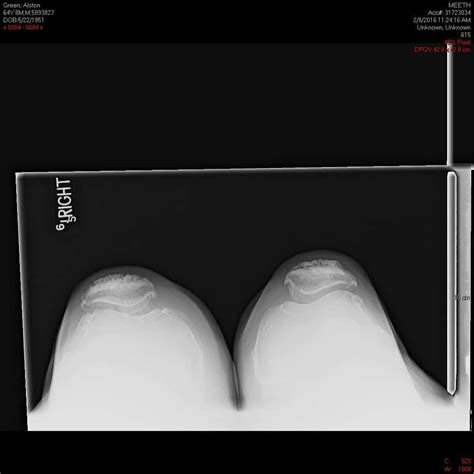 Case Study Right Total Knee Replacement In A 72 Year Old Female With