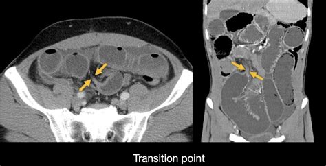 Abdominal Ct Small Bowel Obstruction • Litfl • Radiology Library
