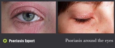 Psoriasis Around Eyes Psoriasis Expert