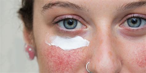 What Is Rosacea Bradford Skin Clinic And Medical Spa
