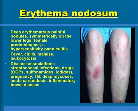 Erythema Nodosum Causes Symptoms And Treatment Health