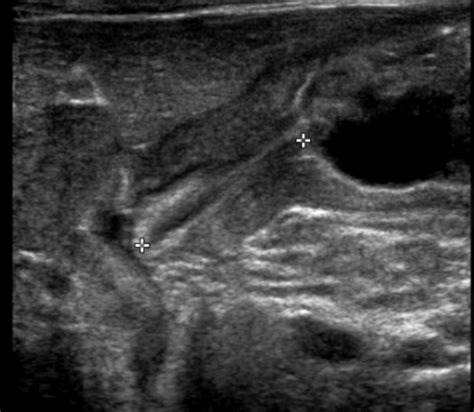 Gastroenteritis refers to an infection of the stomach and the intestine. Pyloric Stenosis - Undergraduate Diagnostic Imaging ...