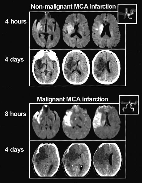 Prediction Of Malignant Middle Cerebral Artery Infarction By Diffusion