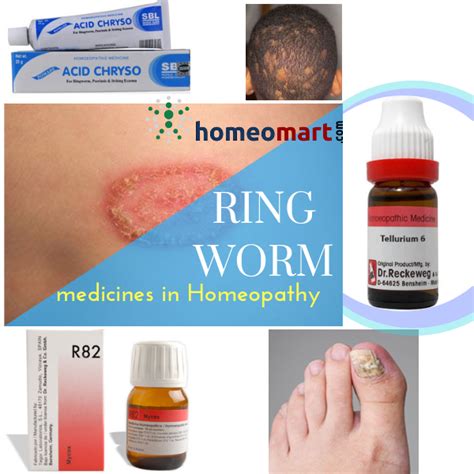 ring worm remedies that act fast are safe and side effect free homeopathy medicine