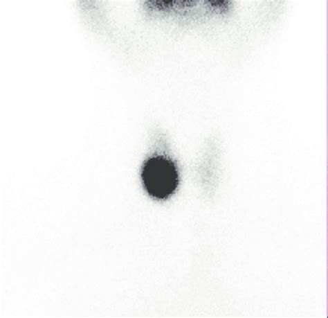 99m Tc Scintigraphy Showing A Hot Nodule At The Right Thyroid Region