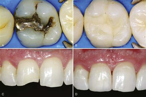 8 Introduction To Composite Restorations Pocket Dentistry