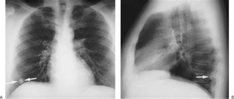 Solitary And Multiple Pulmonary Nodules Chest Radiology The