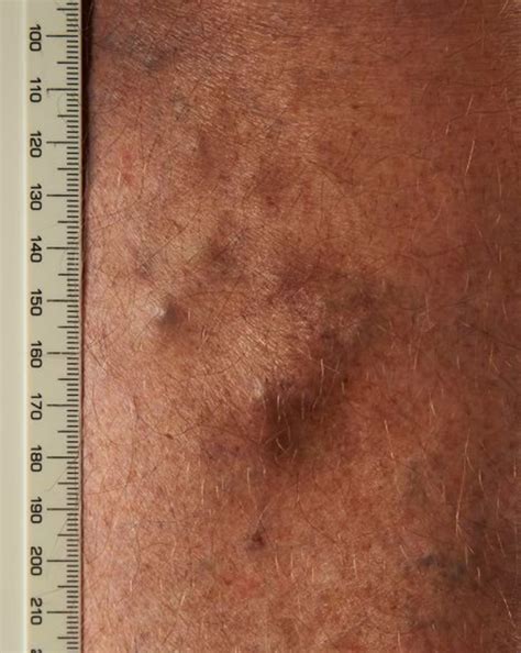 Superficial Thrombophlebitis Superficial Venous Thrombosis The Bmj
