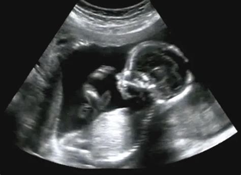 Sonogram Vs Ultrasound By Water Birth