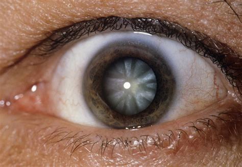 Uv Light And Its Effects To The Eye Oasiseye Specialists