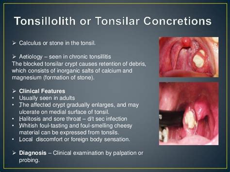 Unilateral Tonsillar Swelling