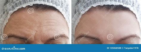 Woman Wrinkles Forehead Before And After Procedures Stock Photo Image