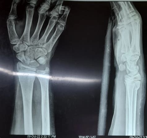 Pain And Swelling Wrist Joint