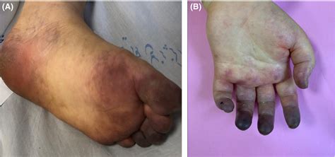 Acrocyanosis And Digital Necrosis Are Associated With Poor Prognosis In