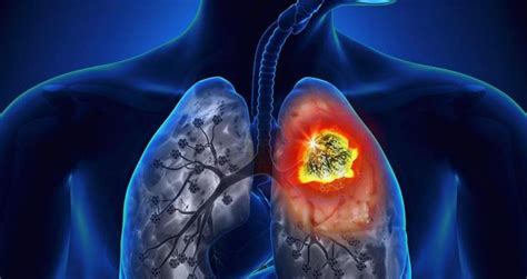 Asbestosis qué es síntomas diagnóstico consecuencias y más