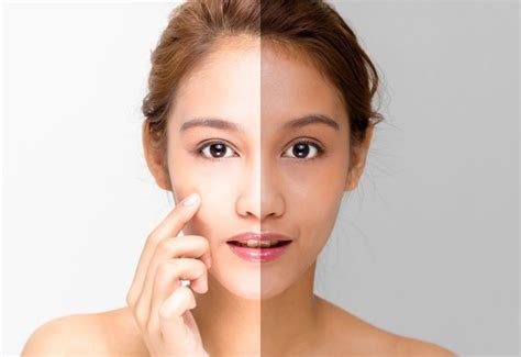 Secreto japonés para eliminar las manchas del rostro Manchas de acne