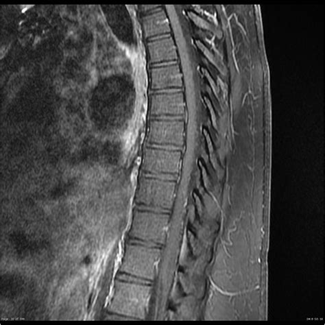 Tests that can indicate a diagnosis of. Transverse myelitis | Image | Radiopaedia.org