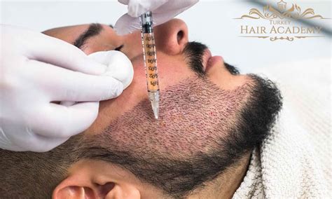 Beard Transplant Guide 2022 Prices Procedures Best Clinic
