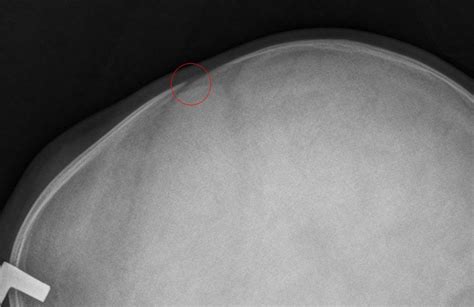 Ultrasound Beats Xray For Skull Fracture Ede Blog