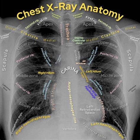 How To Read Chest X Ray Chest X Ray Anatomy Chest X Ray Pa View Sexiz Pix