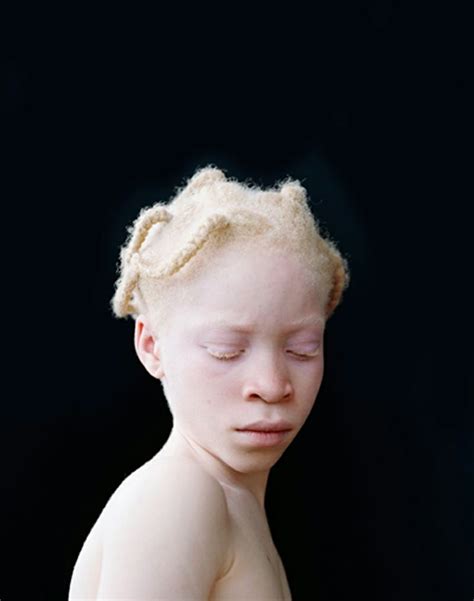 Albino Girl Albino Human Albinism Portrait