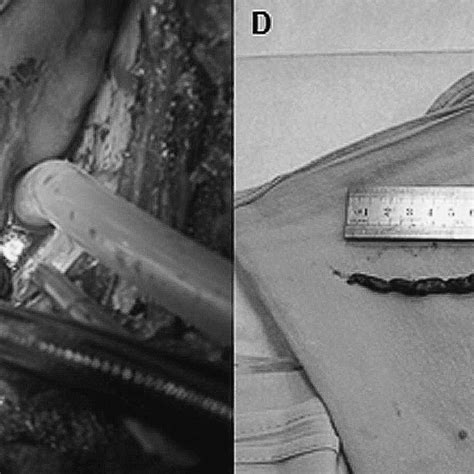 C An Intraoperative View Of The Opened Right Atrium Showing The