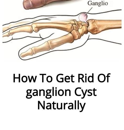 How To Get Rid Ganglion Cyst Margaret Greene Kapsels