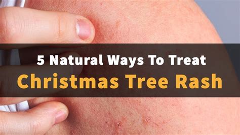 Natural Ways To Treat Christmas Tree Rash Youtube