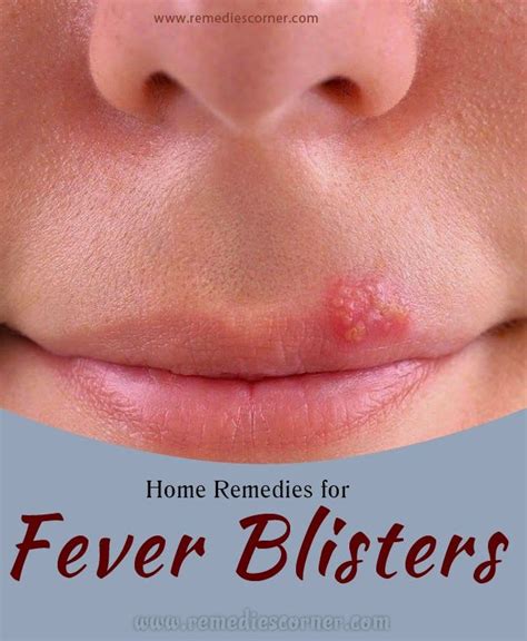 Home Remedies For Fever Blisters Remedies Corner Blister Remedies