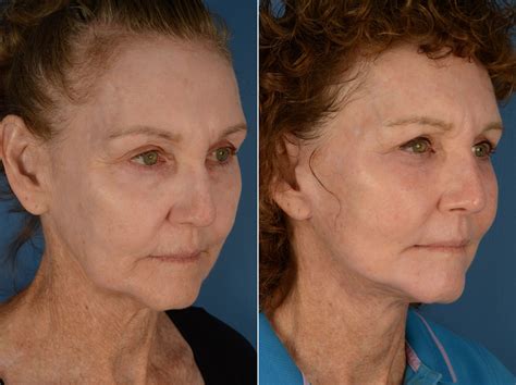 The Uplift™ Lower Face And Neck Lift Photos Naples Fl Patient 12920
