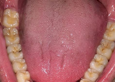Update Image What Are The Black Lines On My Teethmolars R