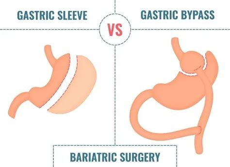 Gastric Sleeve Vs Gastric Bypass Whats The Difference Bariatric
