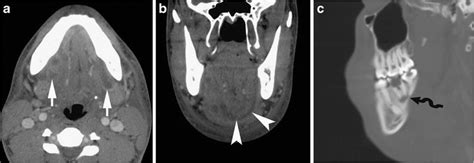 Ludwigs Angina In A 20 Year Old Woman Who Presented With Rapidly