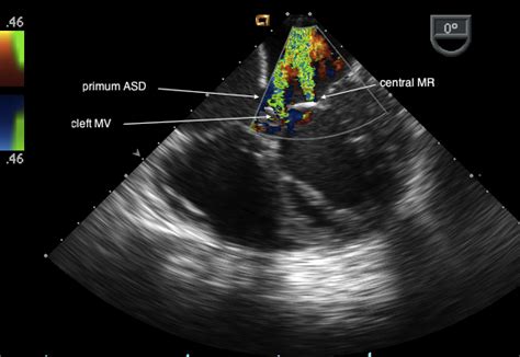 Catheterization preoperative cardiac catheterization was performed in 45 patients (39%). Atrial Septal Defects