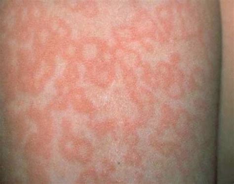 7 Types Of Rashes You Should Never Ignore These Are The