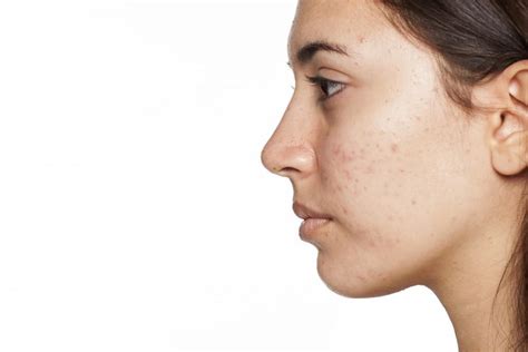 What Causes Adult Acne And What Can You Do About It Specialists In