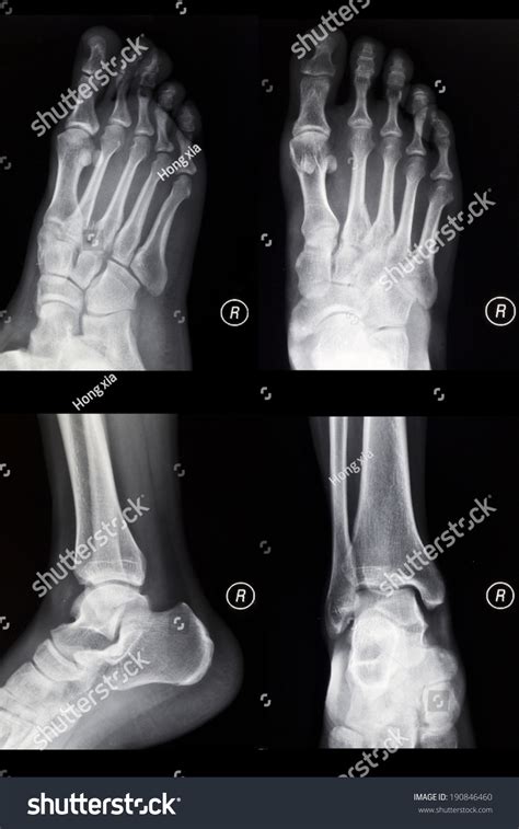 Foot Oblique Ankle Lateral Xray Film Stock Photo 190846460 Shutterstock
