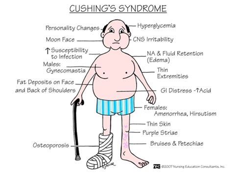 Cushings Syndrome Signs And Symptoms