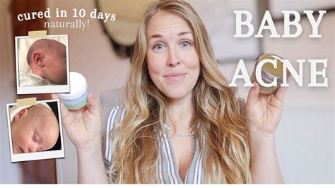 Get Rid Of Baby Acne Naturally Newborn Acne Cure Youtube