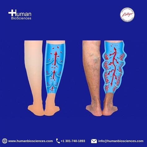 Venous Leg Ulcers Treatment Symptoms Diagnosis Signs