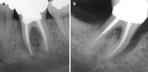 Vertical Root Fracture Treatment