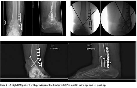 Arthroscopic Ankle Arthrodesis A Gold Standard In Current Management