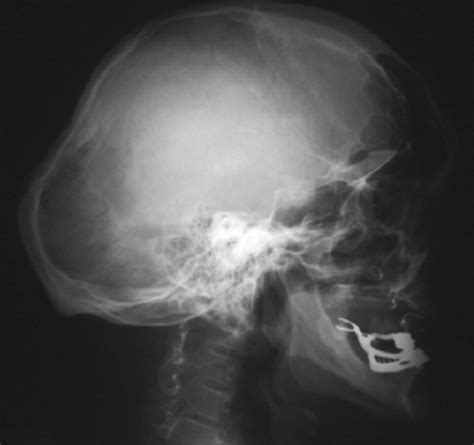 Lateral Skull Radiographs Showed Significant Frontal And Occipital
