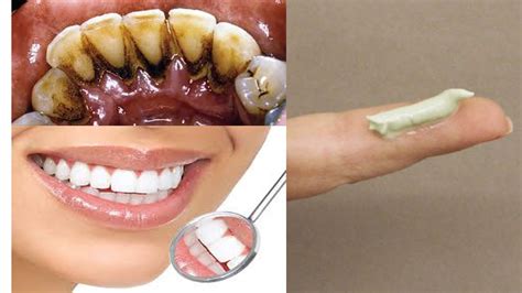 How To Whiten Teeth At Home In 3 Days And Remove Tartar And Black Teeth