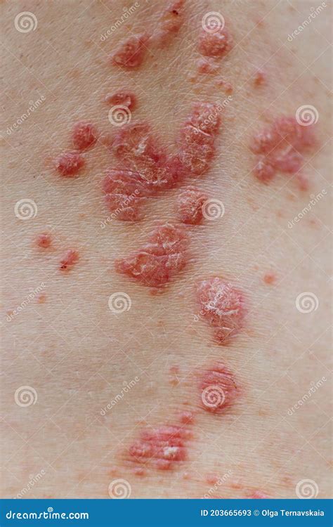 back view of woman with dermatitis problem of rash and itchy dry skin stock image image of