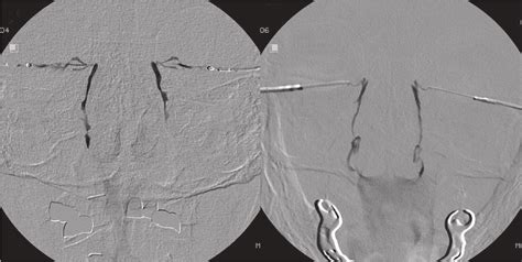 A Dacryocystographic Image Of The Patient In Case 1 Revealed Focal