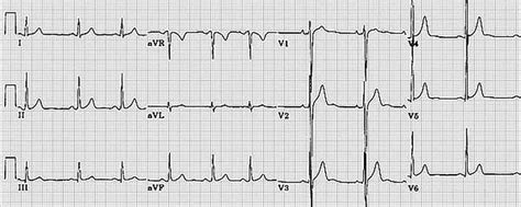 Normal Versus Abnormal Ecg Classification By The Aid Of Deep Learning