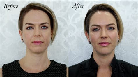 Top 19 Juvederm Jowls Before And After