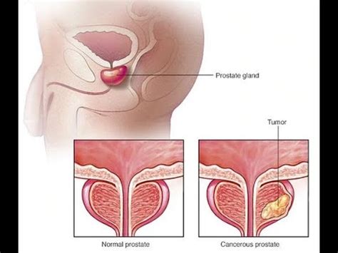 Click on the article title to read more. prostate cancer symptoms diagnosis treatment and more ...
