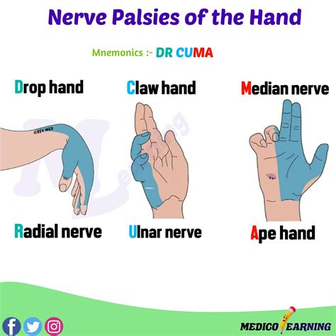 Nerve Palsies Of Hand Mnemonic Medicolearning
